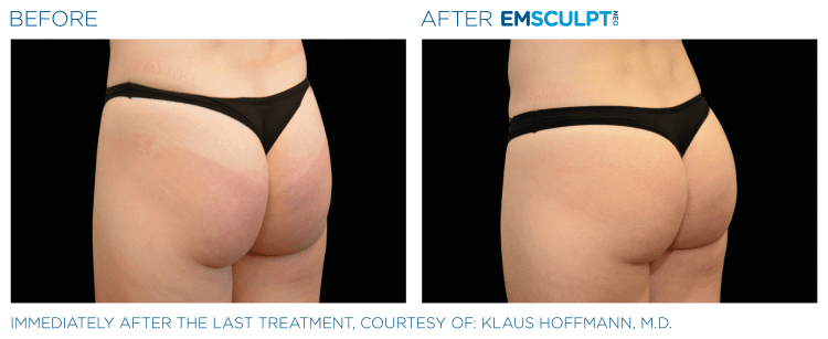 EMSULPT NEO before and after | The Healy Clinic