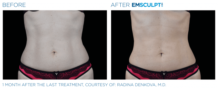 EMSULPT NEO before and after | The Healy Clinic