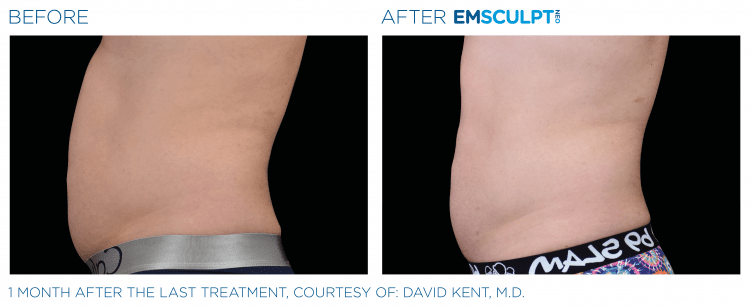 EMSULPT NEO before and after | The Healy Clinic