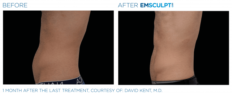 EMSULPT NEO before and after | The Healy Clinic