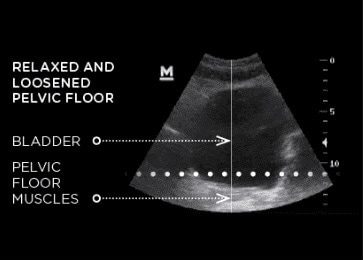 EMSELLA before ultrasound | The Healy Clinic