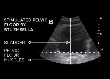 EMSELLA after ultrasound | The Healy Clinic