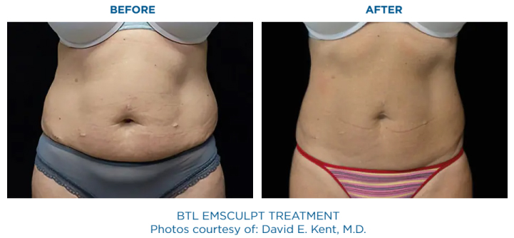 EMSULPT NEO and EMSELLA before and after | Core to Floor | The Healy Clinic