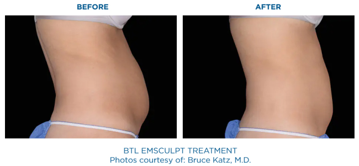 EMSULPT NEO and EMSELLA before and after | Core to Floor | The Healy Clinic