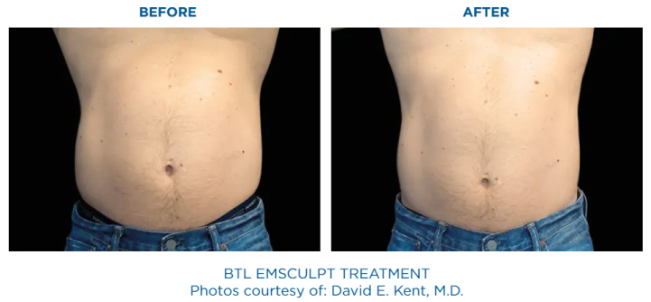 EMSULPT NEO and EMSELLA before and after | Core to Floor | The Healy Clinic